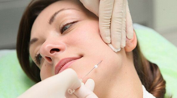 Thread lifting - a method of cosmetic facial rejuvenation after 45 years