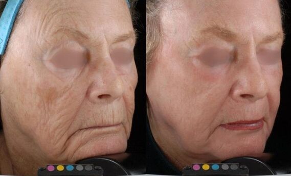 photography before and after laser rejuvenation