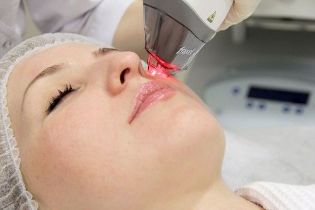 The process of facial skin rejuvenation with a fractional laser