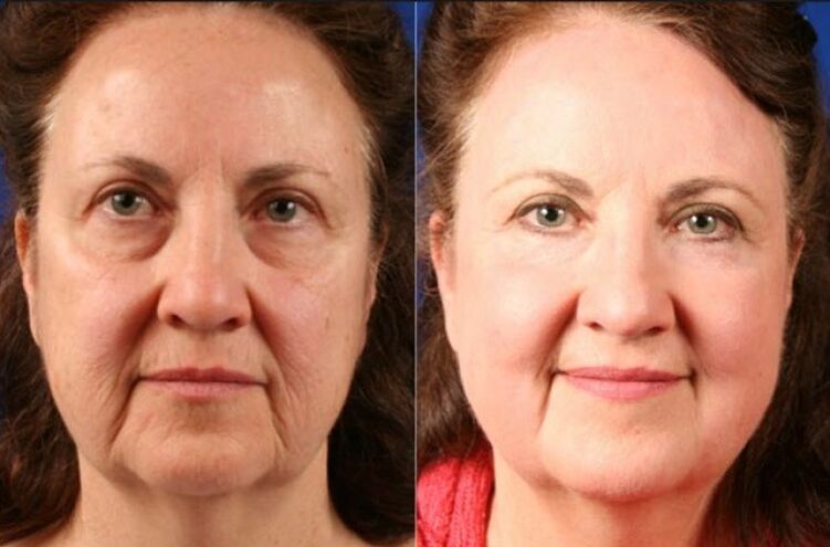 before and after using the rejuvenating massager ltza photo 6