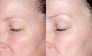rejuvenating the skin around the eyes before and after photos