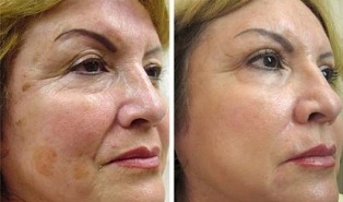 fractional skin rejuvenation before and after photographs