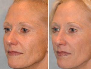 Before and after microcurrent therapy