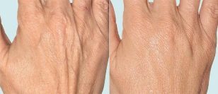 Skin of hands before and after fractional therapy
