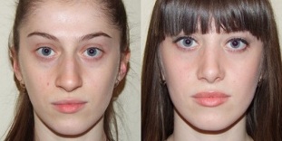 before and after skin rejuvenation in plasma