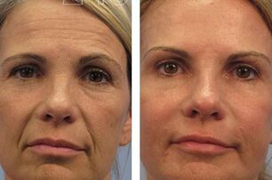 the result of mesotherapy